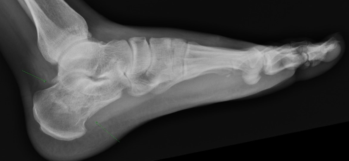 calcaneus-fracture-2.jpg