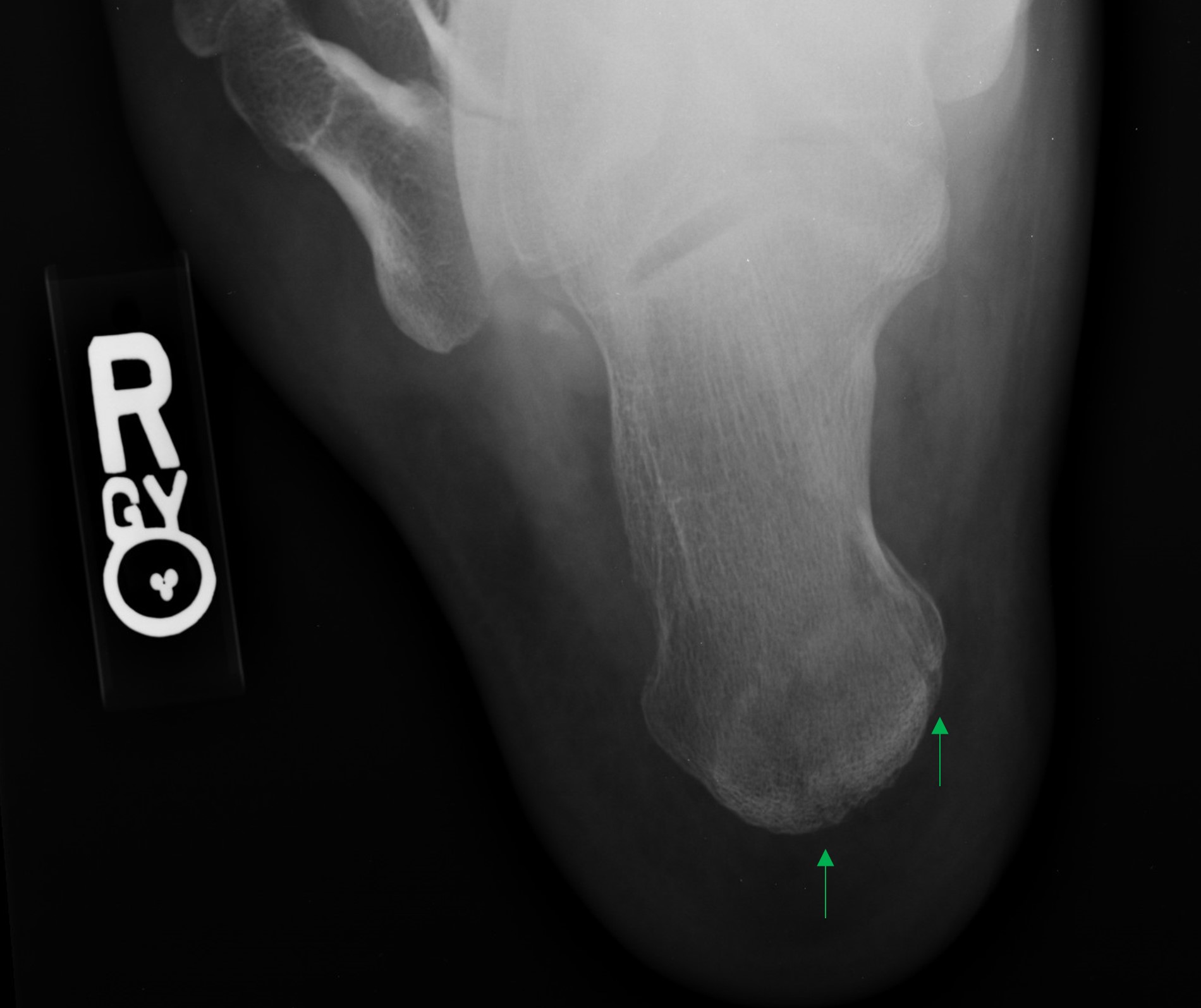 Foot Case 4 Additional Images: Orthopedic Teaching: Feinberg School of  Medicine