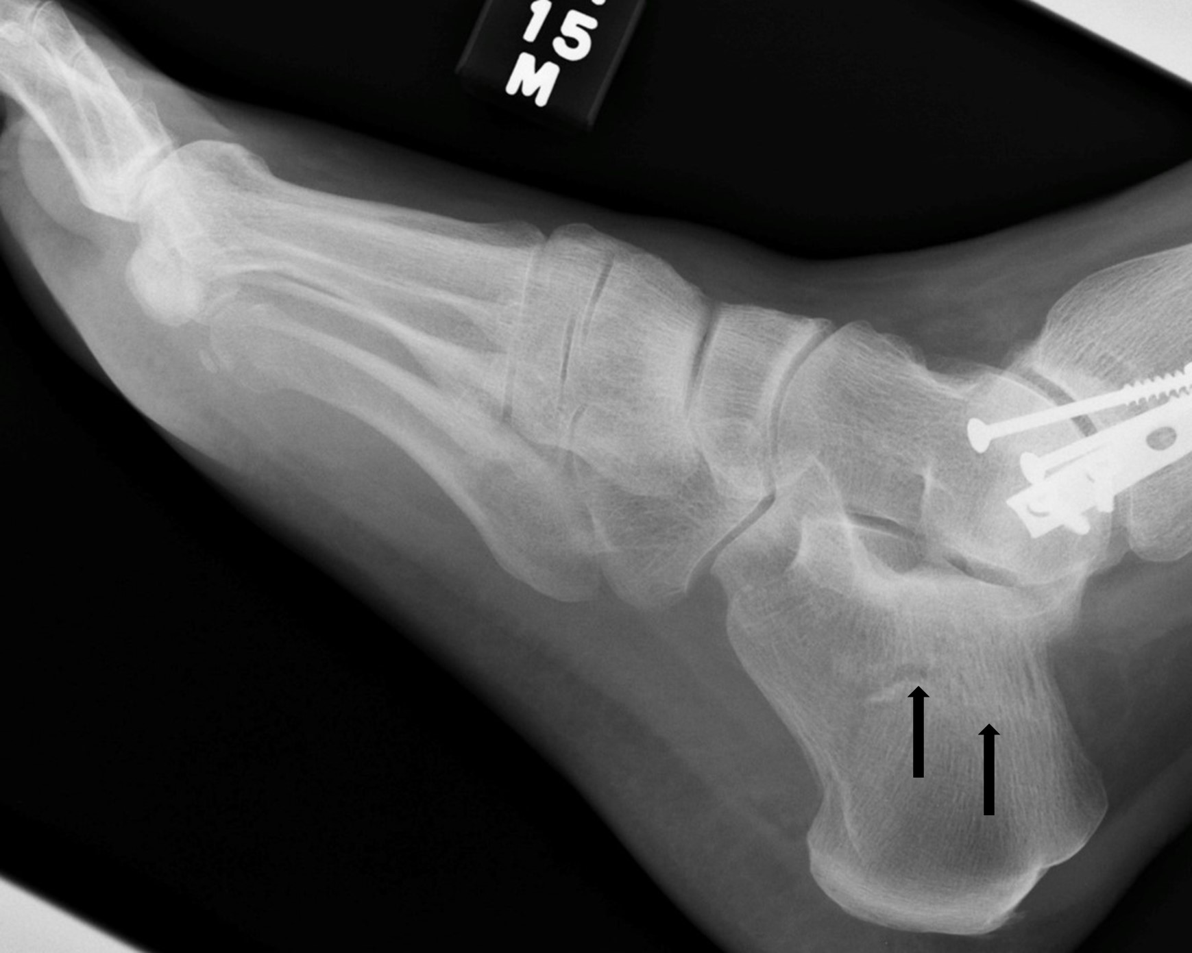 Fractures and dislocations of the tarsal bones | Anesthesia Key