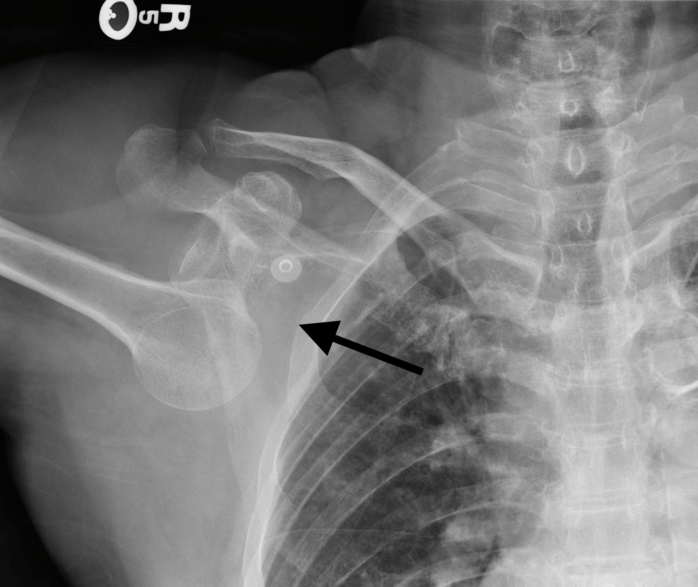 inferior-shoulder-dislocation-answer.jpg