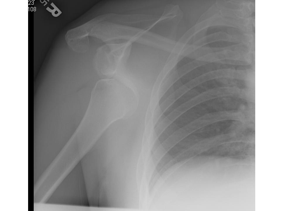 inferior-shoulder-dislocation.-luxatio-erecta-1.jpg