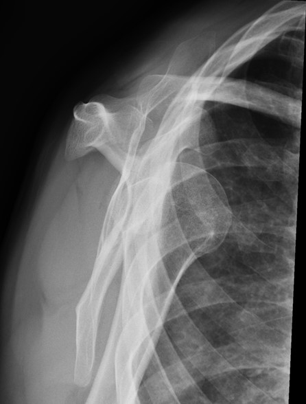 shoulder-dislocation-anterior-x-ray-1.jpg