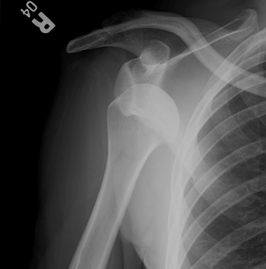 shoulder-dislocation-anterior-x-ray-2.jpg