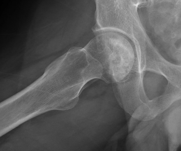 This image of stage 2 AVN has a mixed picture of osteopenia and sclerosis with subchondral cystic changes.