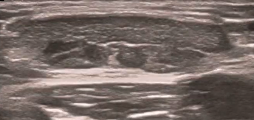 Achilles Tendon Injury: Orthopedic Teaching: Feinberg School of Medicine