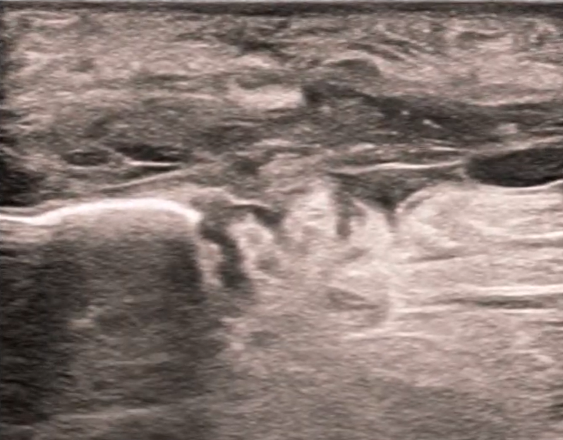 Achilles Tendon Injury: Orthopedic Teaching: Feinberg School of Medicine