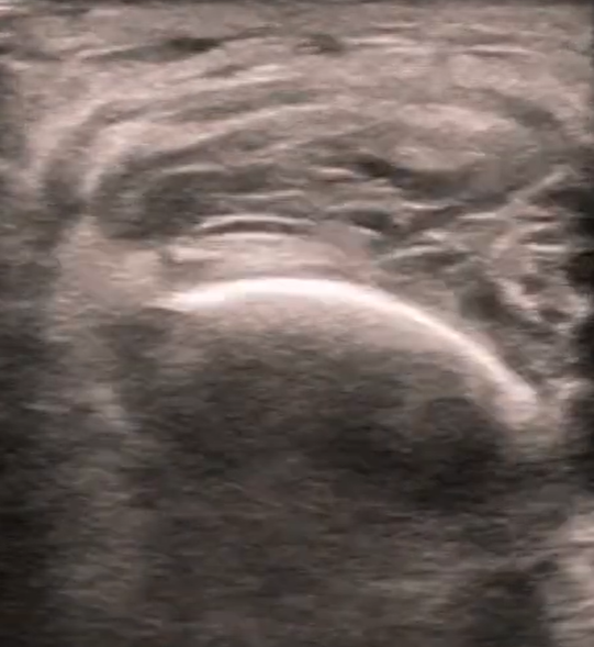 Achilles Tendon Injury: Orthopedic Teaching: Feinberg School of Medicine