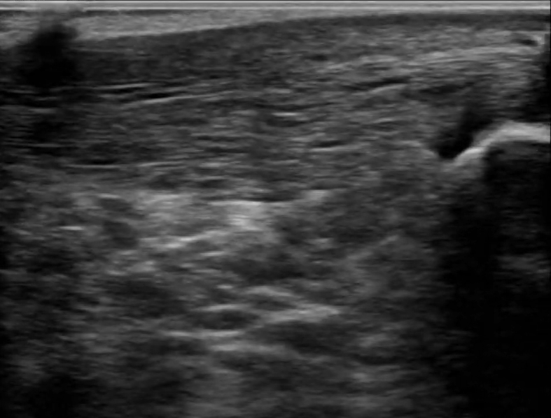 Achilles Tendon Injury: Orthopedic Teaching: Feinberg School of Medicine