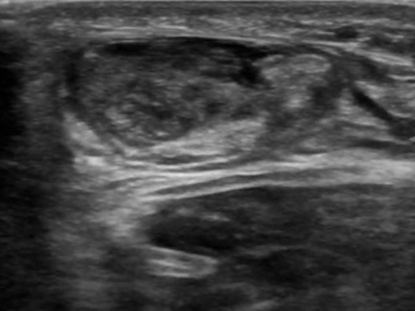 Achilles Tendon Injury: Orthopedic Teaching: Feinberg School of Medicine