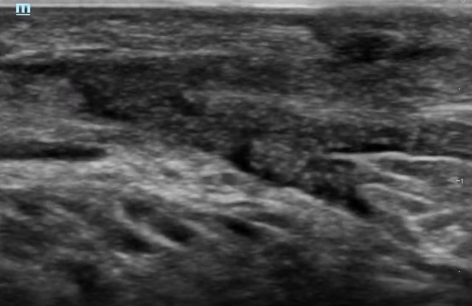 Achilles Tendon Injury: Orthopedic Teaching: Feinberg School of Medicine