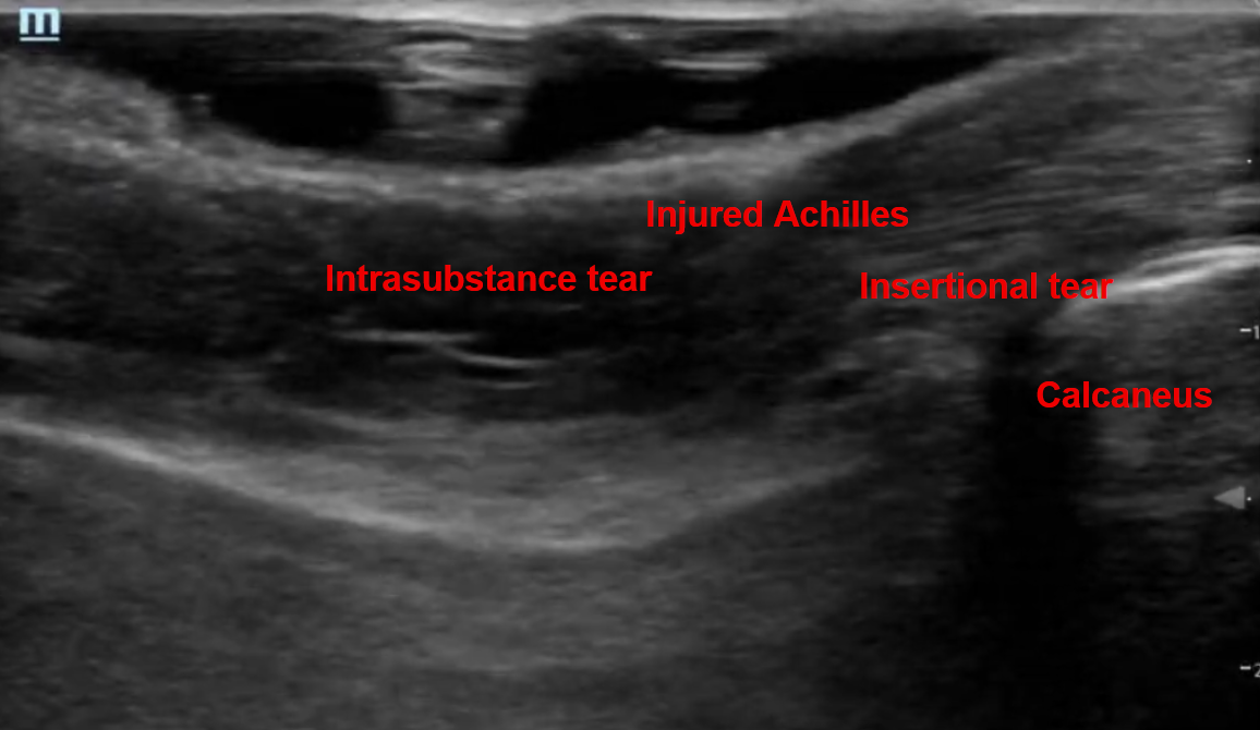 Pathologic Achilles: Orthopedic Teaching: Feinberg School of Medicine