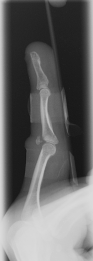 dorsal plate fracture