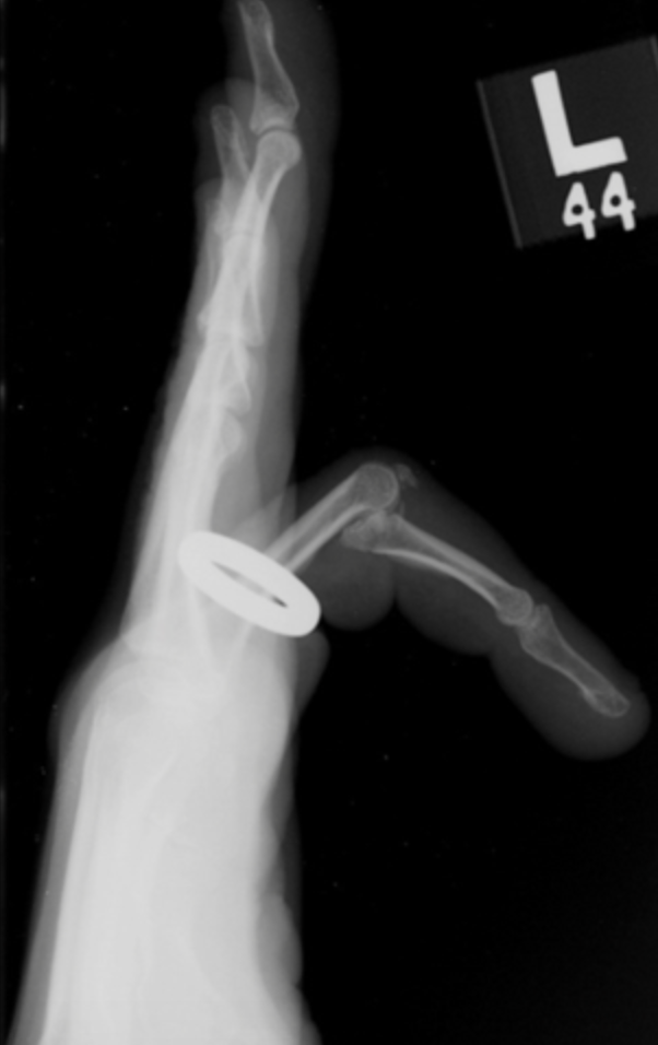PIP dislocation