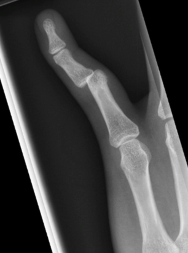PIP dislocation