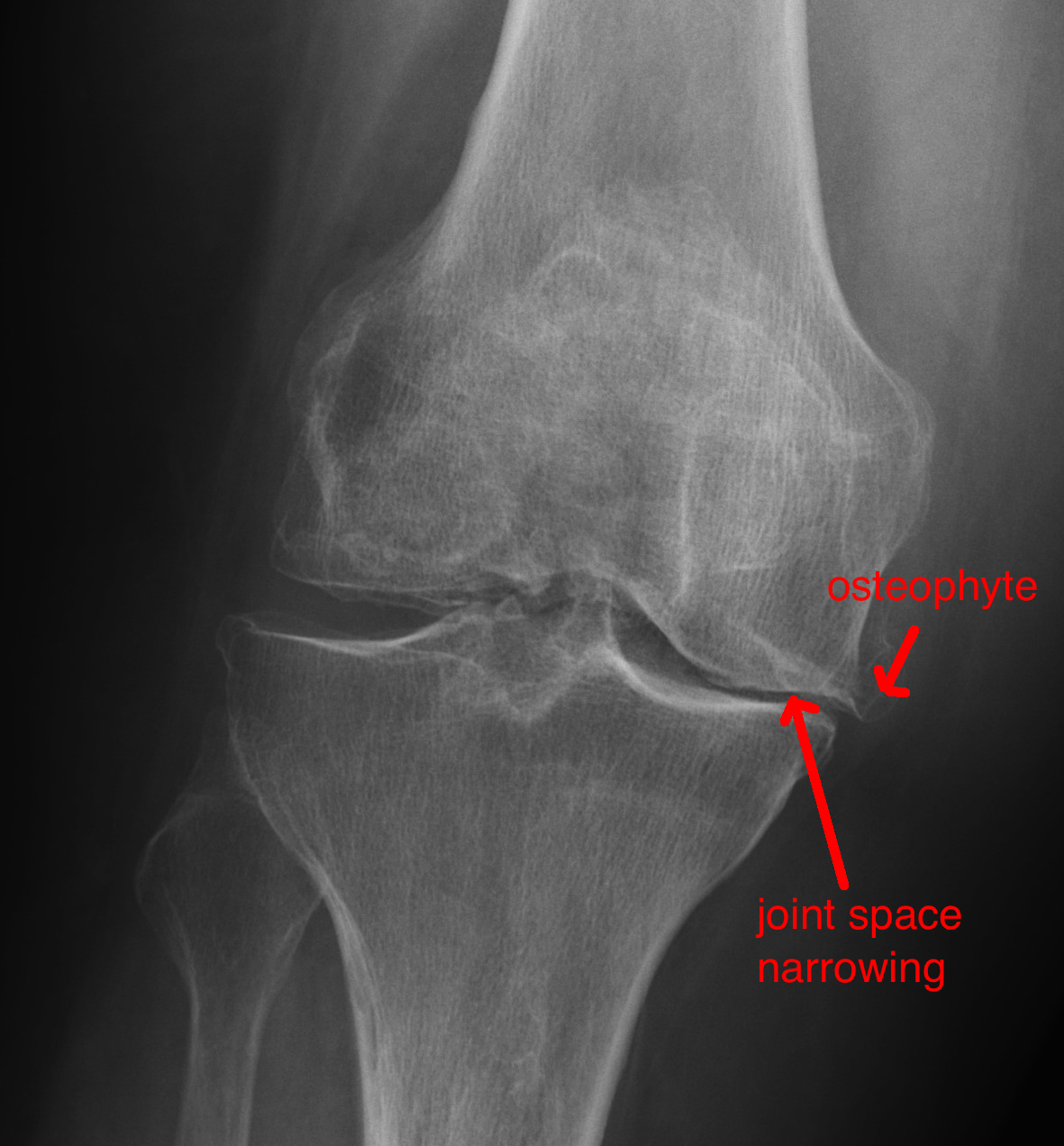 Joint Space Narrowing Knee Meaning At Herman Genovese Blog
