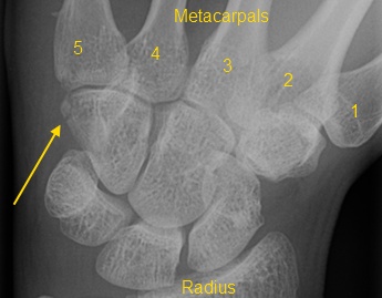 Wrist Case 9 Diagnosis: Orthopedic Teaching: Feinberg School of Medicine