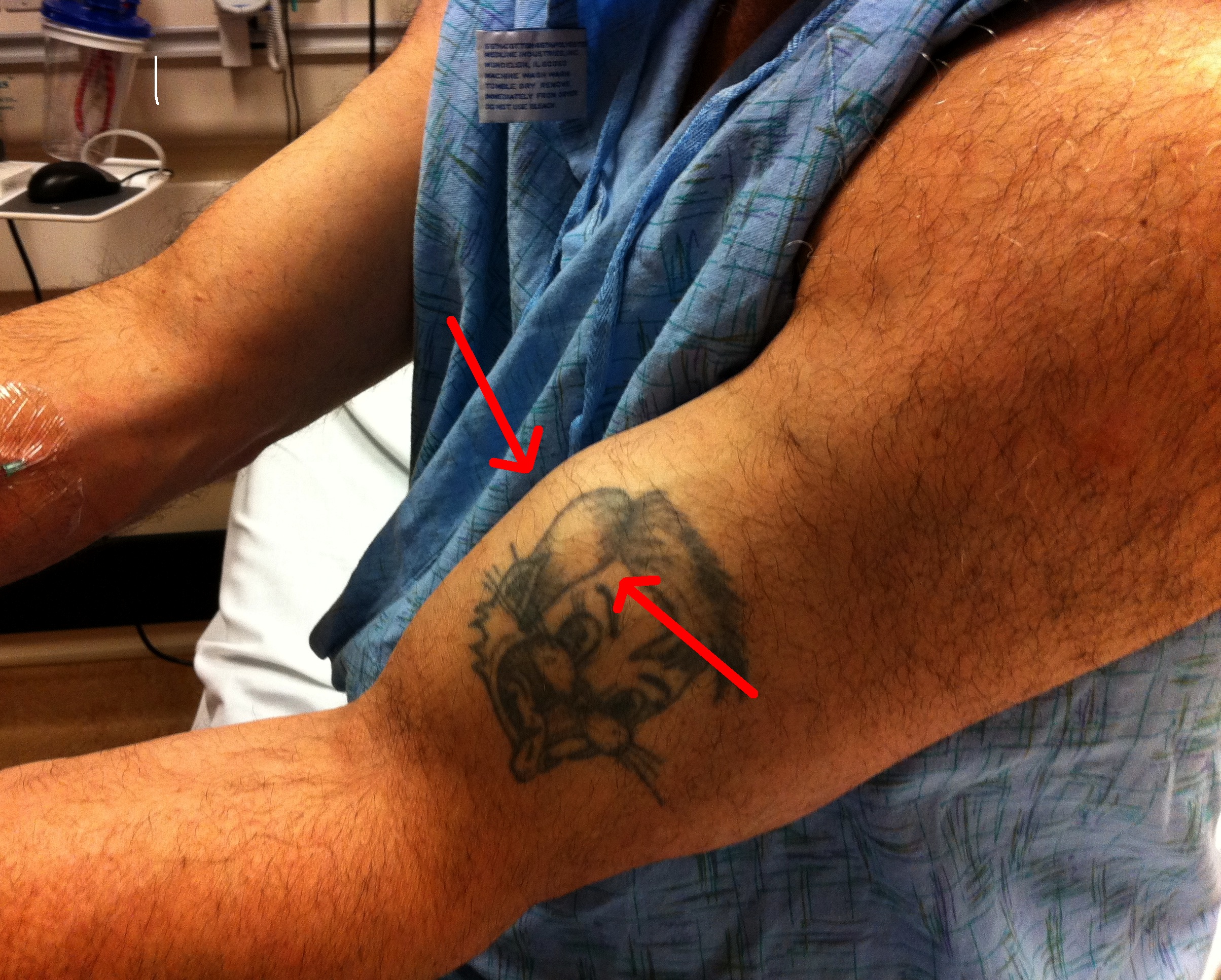 biceps tendon rupture