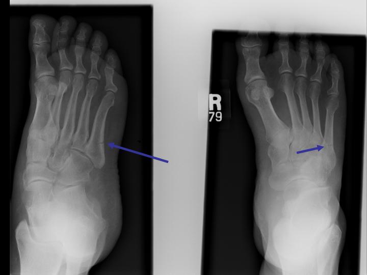 How To Tell if Your Foot Is Fractured - Heiden Orthopedics