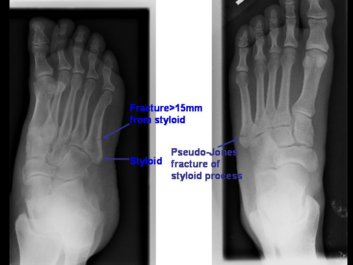 Pseudo Jones Fracture