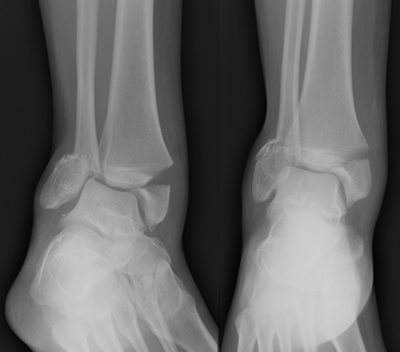 Ankle Case 3 Background: Orthopedic Teaching: Feinberg School of Medicine