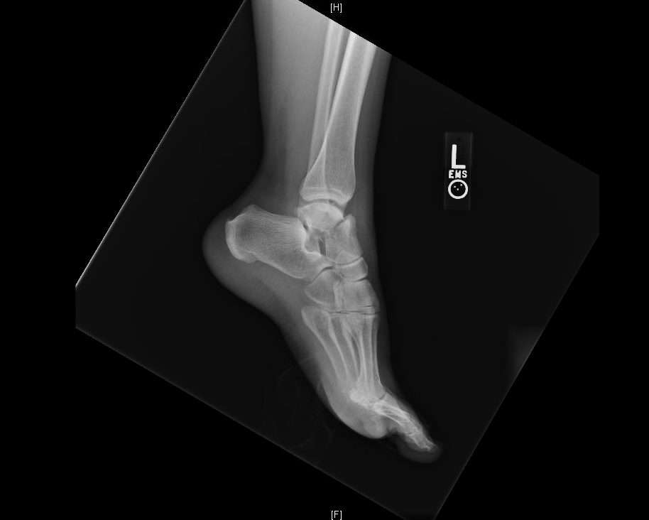 talusfracture