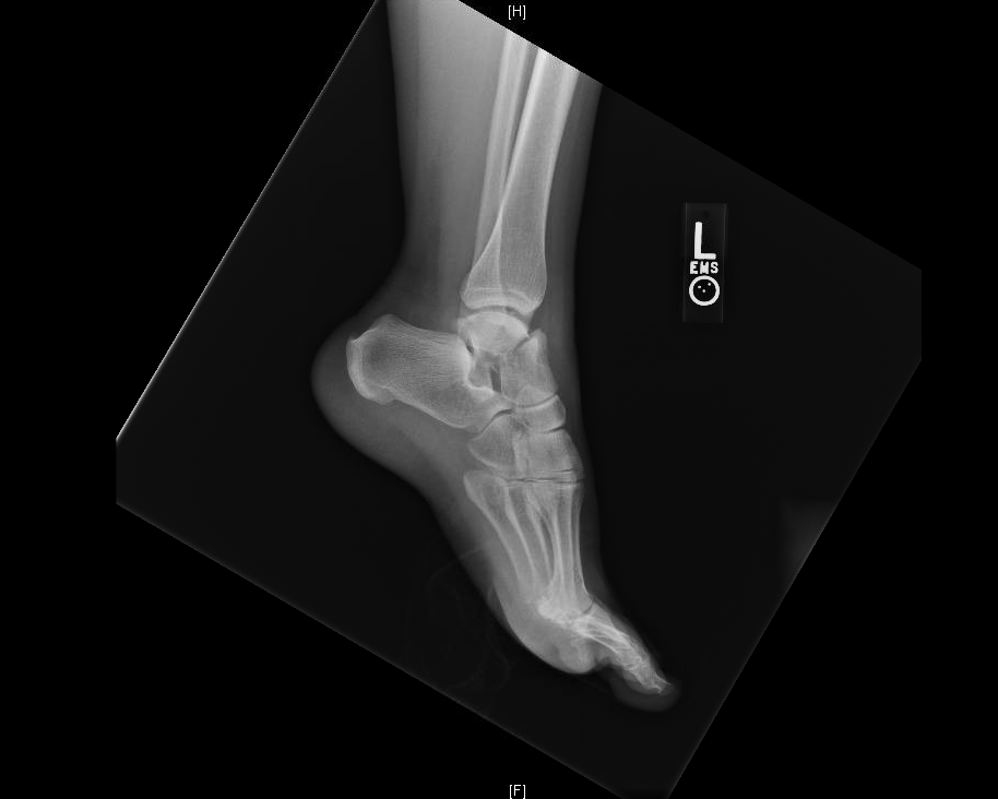 talus fracture