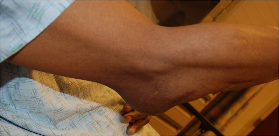 Olecranon Bursitis