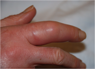 Flexor Tenosynovitis