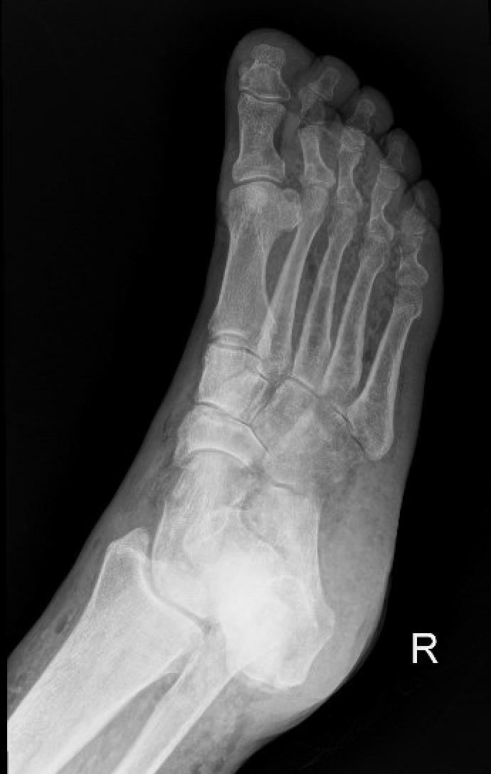subcutaneous air on xr foot 