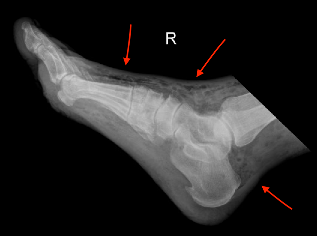 necrotizing fasciitis xray