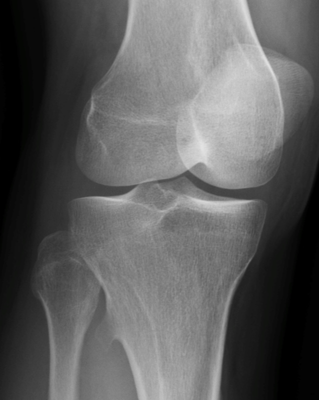 Osteochondroma