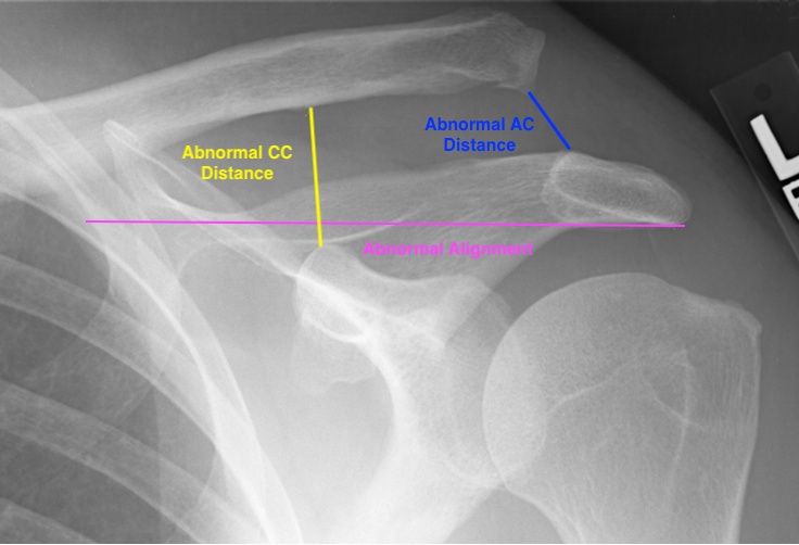 ac separation