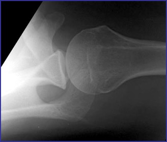Shoulder X Ray Lateral