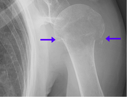 humeral neck ap view
