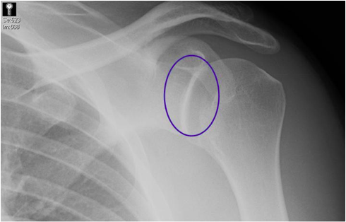 glenohumeral overlay abnormal