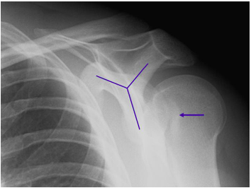 impaction fracture