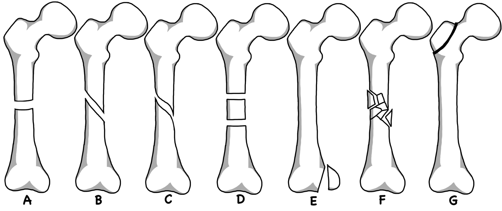 fracture description